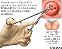 Biópsia cervical