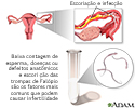 Infertilidade primária
