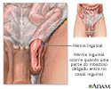 Hérnia inguinal