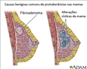 Causas de nódulos mamários