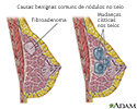 Causas de nódulos mamários