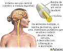 Esclerose múltipla