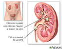 Nefrolitíase