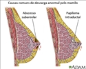 Corrimento anormal do mamilo
