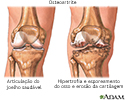 Osteoartrite