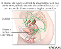 Perigos do câncer de ovário
