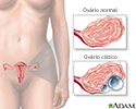 Cistos ovarianos