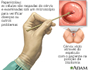 Papanicolau