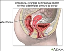 Aderências pélvicas