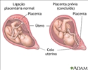 Placenta prévia