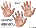 Fenômeno de Raynaud