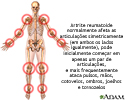 Artrite reumatoide