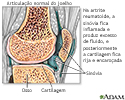 Artrite reumatoide