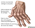 Artrite reumatoide