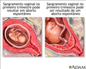 Sangramento vaginal na gestação