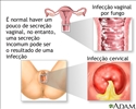 Corrimento vaginal