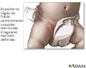 Assaduras de fralda