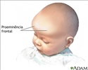 Protuberância frontal