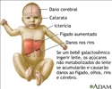 Galactosemia