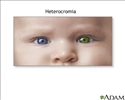 Heterocromia