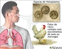 Histoplasmose aguda