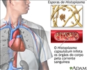 Histoplasmose disseminada