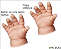 Prega simiesca
