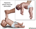 Hipotonia