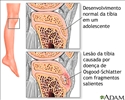 Dor na perna (Osgood-Schlatter)