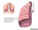 Tuberculose miliar
