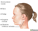Mononucleose infecciosa