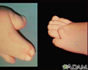 Syndactyly