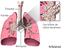 Carcinoma de células escamosas