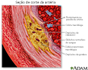 Visualização ampliada da aterosclerose