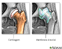 Osteoartrite vs. artrite reumatoide