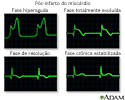 Traçado de ondas de ECG pós-infarto do miocárdio