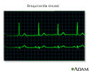 Bradicardia