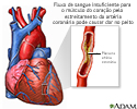 Angina