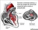 Estenose aórtica