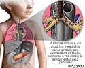 Fibrose cística