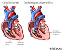 Cardiomiopatia hipertrófica