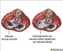 Estenose mitral