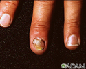 Infecção nas unhas provocadas por cândida