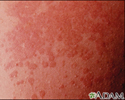 Tinea versicolor - aproximação