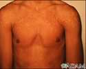 Tinea versicolor - ombros