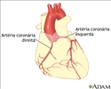 Angioplastia coronária com balão - série