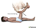 Sinal de Kernig da meningite
