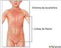 Sinais de febre escarlate