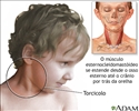 Torcicolo (pescoço torto)