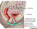 Prevenção da cistite